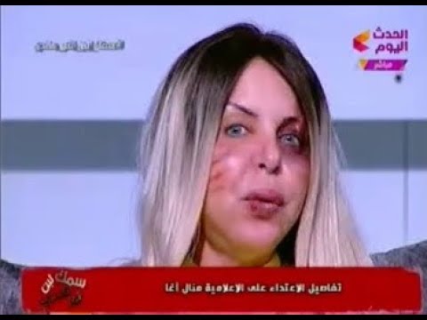 الإعلامية منال أغا تظهر على الهواء مباشرة وعلامات الضرب على وجهها