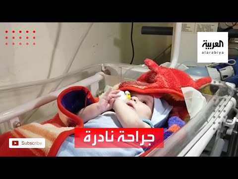 نجاح جراحة نادرة لرضيع مولود بتشوه خلقي في مأرب